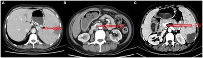 Case report: Paroxysmal nocturnal hemoglobinuria presenting with hemorrhagic esophageal varices